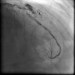 Abb. 15: Direct Stenting