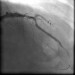 Aktuelles Bild - Abb. 17: Direct Stenting
