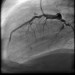 Abb. 18: Direct Stenting