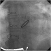 Abb. 7: Aortenklappenprothese