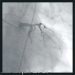 Abb. 1: Ramus circumflexus