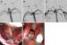 Abb. 2a-e: Mikrochirurgische Clippung