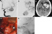 Abb. 6a-e: Angiogramme