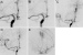 Abb. 10a-e: Angiogramme