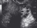 Abb. 2: PCOS