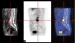 Abb. 2: Ossre Metastase