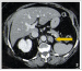 Abb. 3: Nierentumor