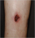 Abb. 10: Pyoderma gangraenosum