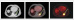 Abb. 3: Pulmonale Metastase