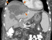 Abb. 3a: MDCT - PTCD