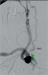 Abb. 10: Subtraktionsangiographie