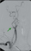 Abb. 11: Subtraktionsangiographie