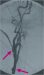 Abb. 13: Kontrollangiographie