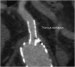 Abb. 5: CT - MIP-Rekonstruktion