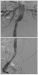 Aktuelles Bild - Abb. 2: Aortenstentgraft