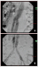 Abb. 4a-b: Aortenstentgraft