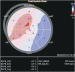Abb. 4: Speckle tracking