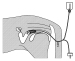 Abb. 1: Embryonengewinnung - Pferd