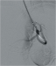 Abb. 5: Stenose