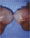 Abb. 1: Vasovasostomie