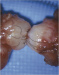 Abb. 4: Vasovasostomie