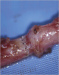 Abb. 6: Vasovasostomie