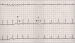 Abb. 1: Reentry-Tachykardie