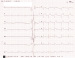 Abb. 1: EKG