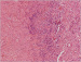 Abb. 3: Grand-mal-Anfall