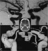 Abb. 1a-d: Arteria carotis - Aneurysma