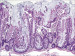 Abb. 2: Lsion - Adenom