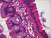 Aktuelles Bild - Abb. 3: Adenom