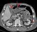 Aktuelles Bild - Abb. 1a: Dnndarmschlinge - Distension