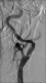 Abb. 6: Angiographie - Stentimplantation