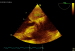 Aktuelles Bild - Abb. 5: Vorhofmyxom