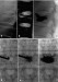 Abb. 3a-f: Vertebral body compression fracture