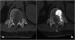 Abb. 4a-b: Neoplastic osteolysis