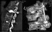 Abb. 1: Cement - Extravasation