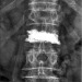 Abb. 3: Lumbar vertebra