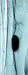 Abb. 11: Insuffizienz der distalen Bypassanastomose