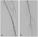 Aktuelles Bild - Abb. 3a-b: Abschlussangiographie