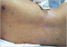 Aktuelles Bild - Abb. 2: Epidermisabhebung