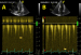 Abb. 8A-B: cw-Doppler im LVOT