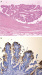 Abb. 2a-b: Neoplasie