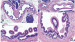 Abb. 3a-d: Neoplasie