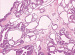 Abb. 5: Neoplasie