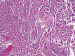 Abb. 6: Neoplasie
