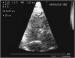 Fig. 2: Koronarfistel