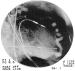 Fig. 3: Koronarfistel