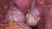 Aktuelles Bild - Abb. 2: Ovarielle Endometriose